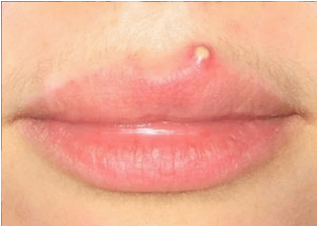唇の赤い隆起 唇のにきび 原因と治療 唇の白い斑点を治療する方法